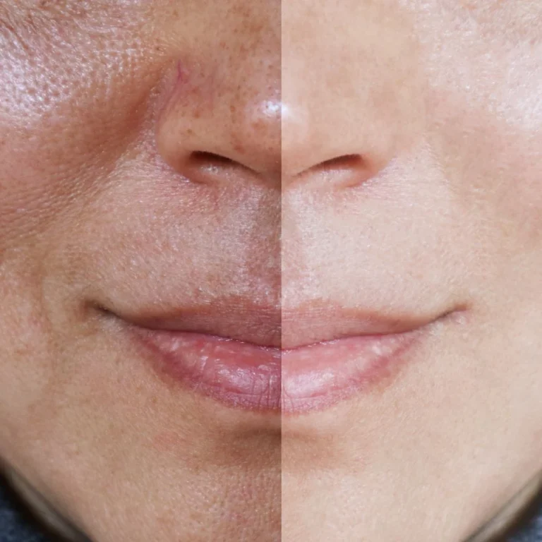 melasma